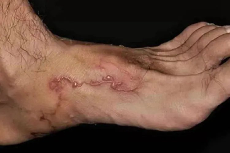 皮肤幼虫移行症脚部红肿图片