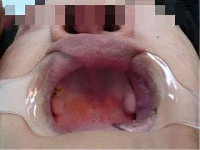 先天性外胚叶发育不良缺损图片