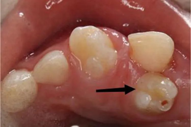 多生牙症状图片