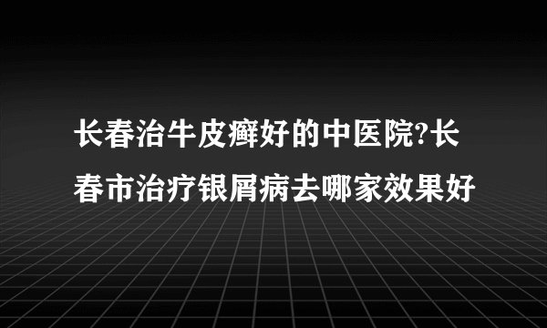 长春治牛皮癣好的中医院?长春市治疗银屑病去哪家效果好