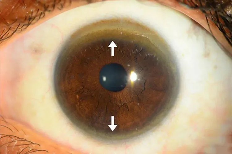 K-F环的眼科图片