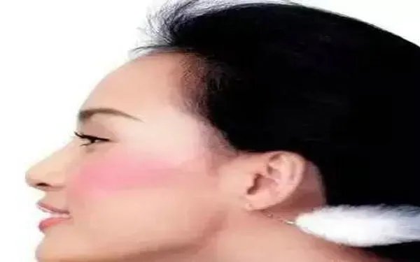 治疗红血丝多少钱？