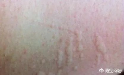 小孩儿一直起荨麻疹怎么治疗？