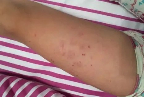 多名孩子身上出现针眼，为何作为老师都如此狠心？