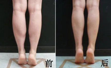 腿部吸脂的价格