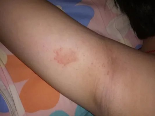 湿疹最佳治疗方法