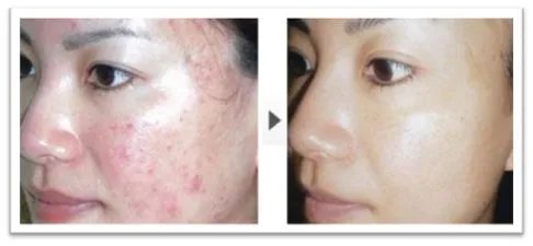 治疗痤疮大概要多少钱