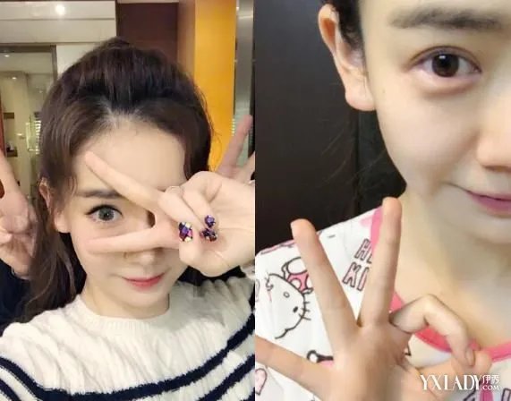 戚薇日本拍戏受伤脸部需缝补晒素颜自拍照向粉丝报平安