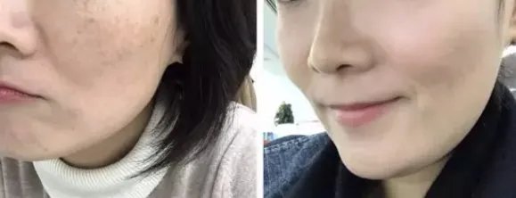 面部激光除皱怎么样，皮秒多久做一次？