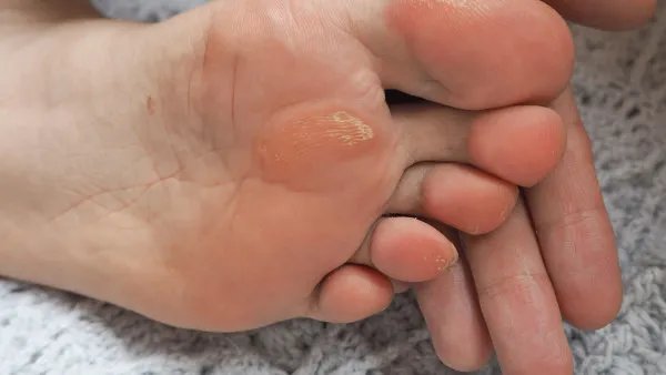 鸡眼是什么样子