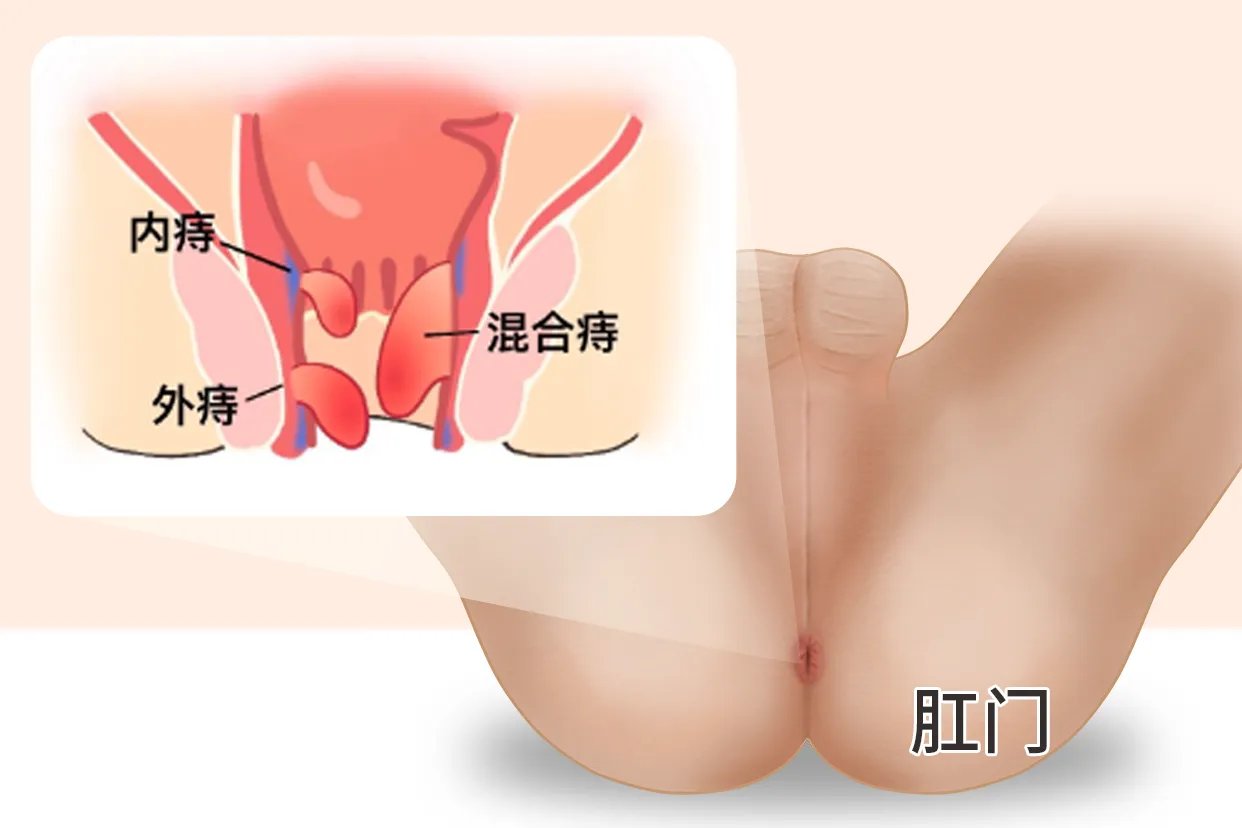 轻度痔疮图片大全
