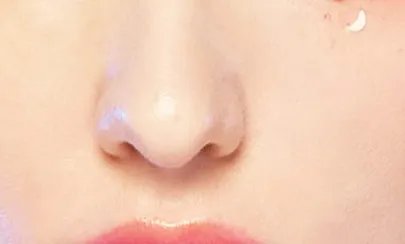 北京驼峰鼻整形医院哪家最好