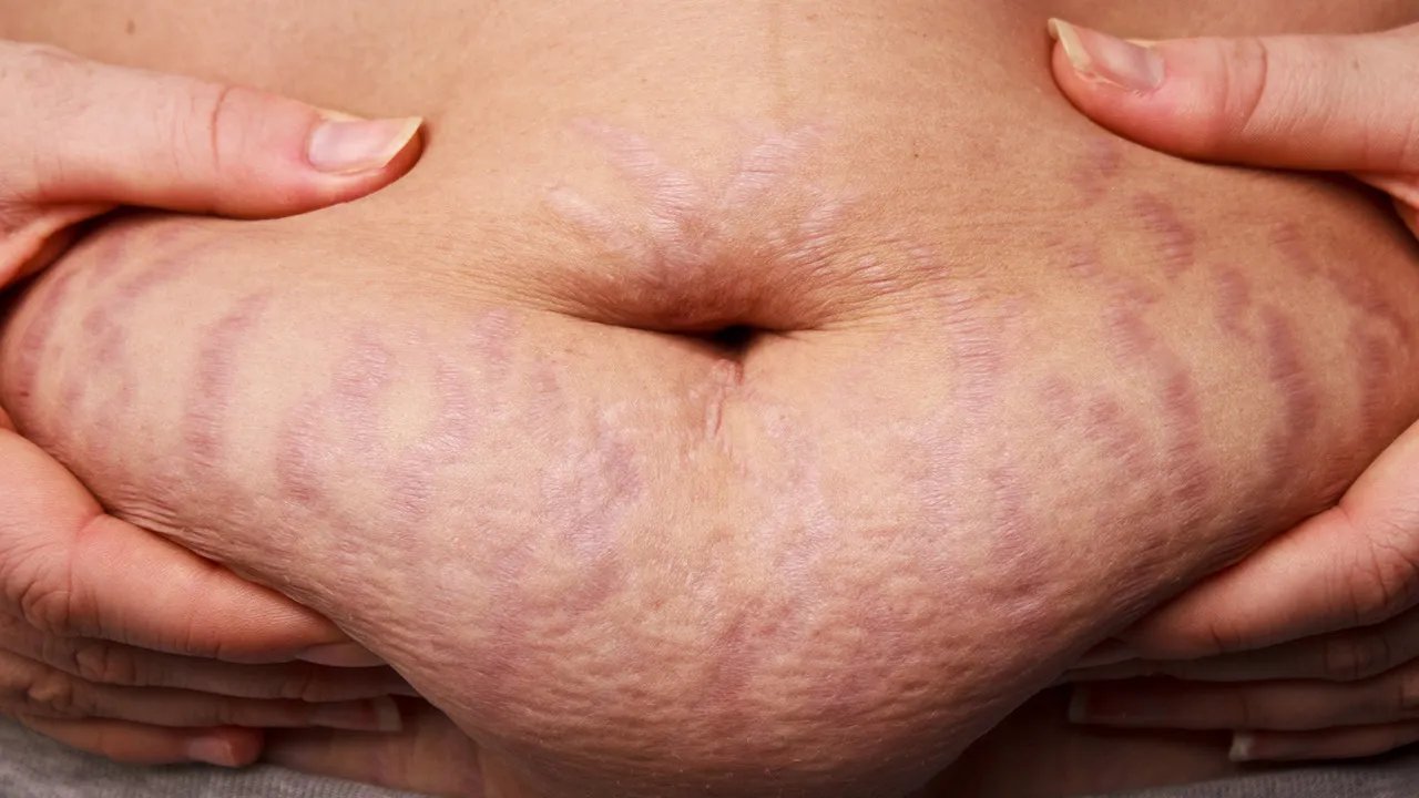 胖的人容易长妊娠纹