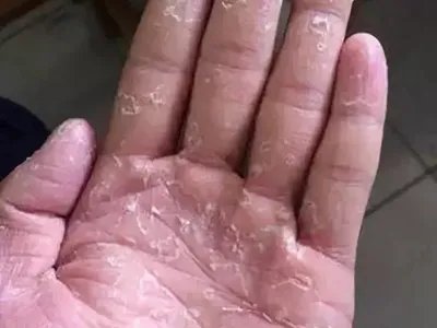 表皮松解性掌跖角皮症手掌皮肤增厚图片