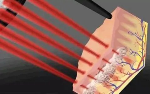 面部激光除皱怎么样，皮秒多久做一次？