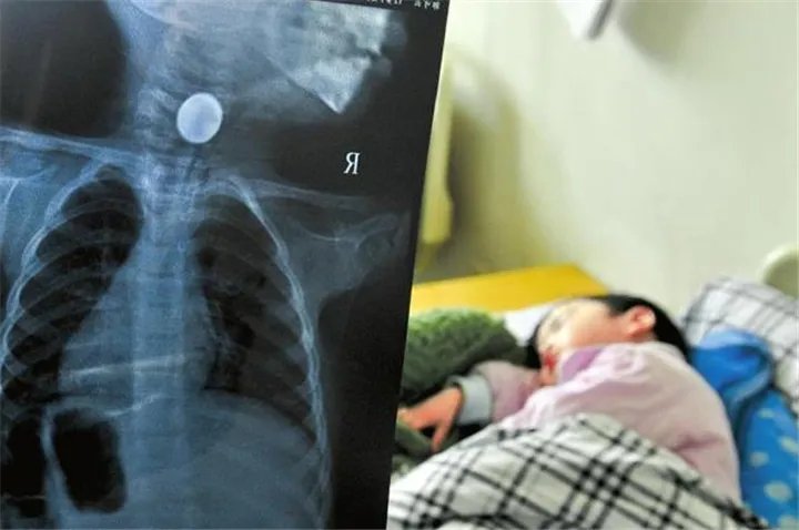 3岁女娃误吞一毛硬币，家长的什么行为差点害了她？