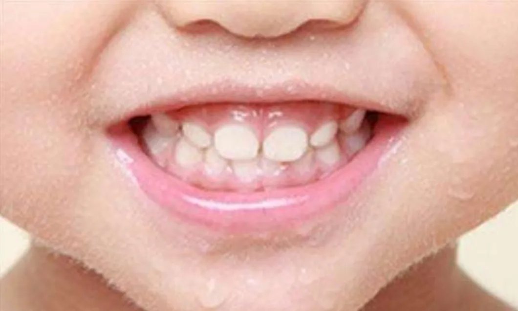 宝宝牙缝宽，都可以塞硬币了，但为什么医生说是好事？