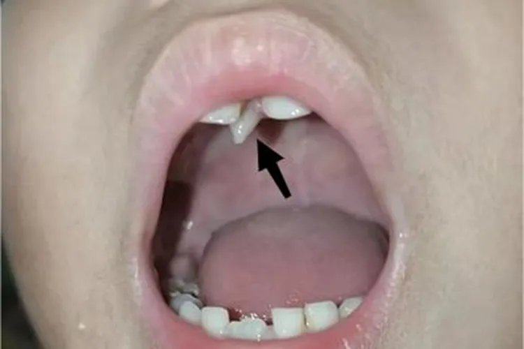 多生牙症状图片