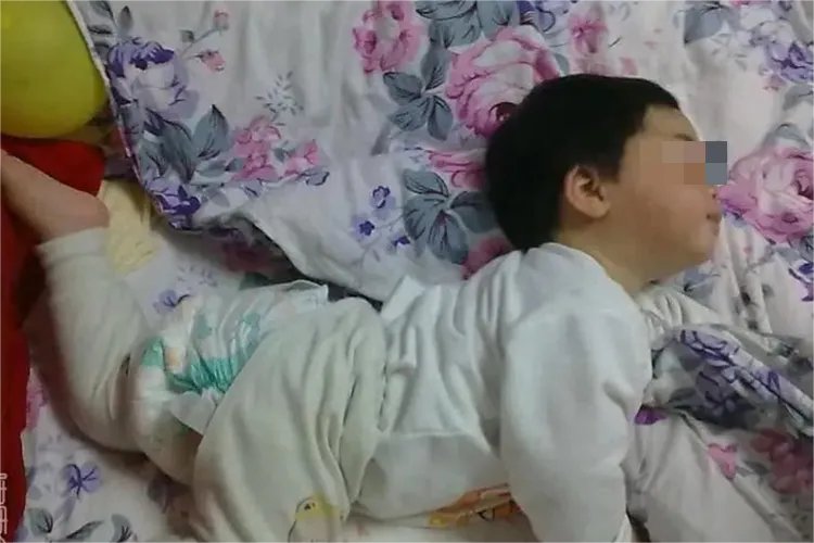 脑瘫的症状图片