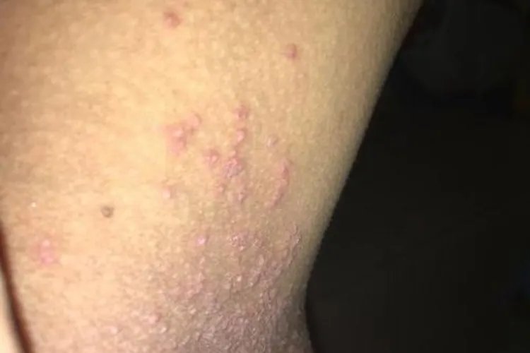 大腿内侧红疙瘩瘙痒图片