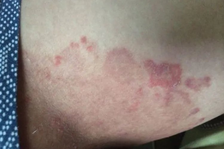 大腿内侧红疙瘩瘙痒图片