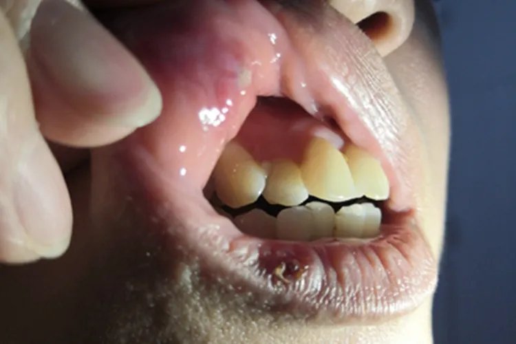 牙列不齐牙齿症状图片