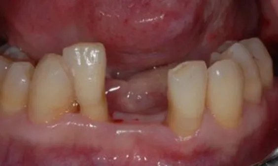 种植满口牙需要多少钱