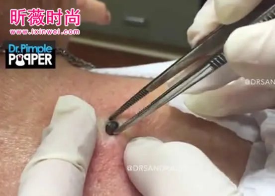 3年黑头被拔出 过程太吓人（图）