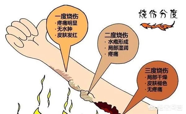 浙江天台足浴店火灾18死18伤，烧伤应如何处理？