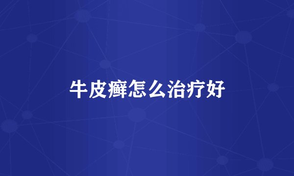 牛皮癣怎么治疗好