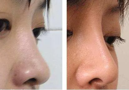 玻尿酸隆鼻的费用是多少