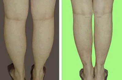 小腿抽脂手术如何