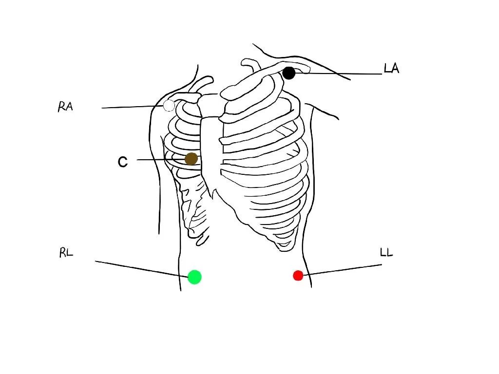心电监护5个电极位置图