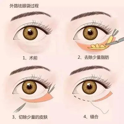 下眼袋松弛怎么办
