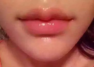 嘴唇整形需要多少钱