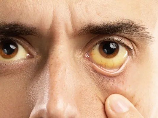  治疗黄疸的方法有哪些