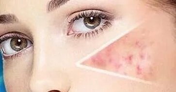 像素激光的副作用