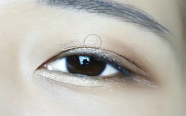 埋线法做双眼皮费用？