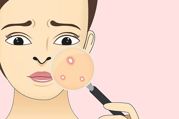 脸颊两边长痘痘是什么原因引起的