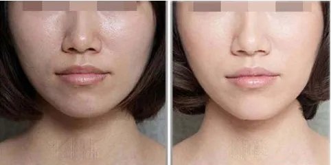 光子嫩肤去红血丝好吗?