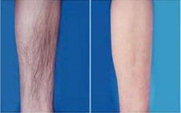小腿激光脱毛的价格