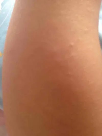 湿疹最佳治疗方法