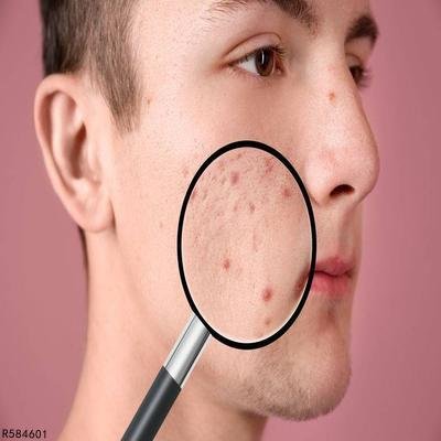 生姜可以去痘坑吗