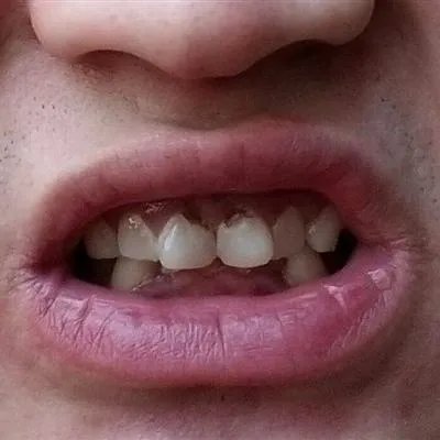 牙龈肿痛怎么办偏方