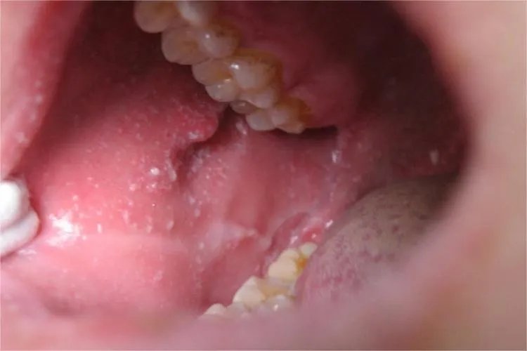 轻型麻疹症状图片