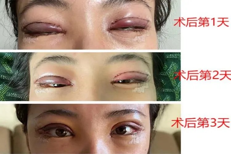 割双眼皮一到七天图片