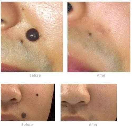 激光点痣多少钱一个啊？