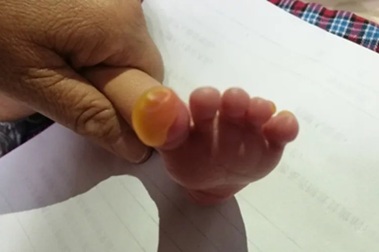 单纯型大疱性表皮松解症脚趾大水疱图片