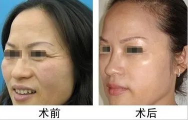 北京热玛吉除皱费用高吗