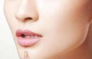 打玻尿酸除皱好不好